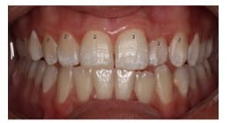 Close up of teeth with mild fluorosis visible as white patches.